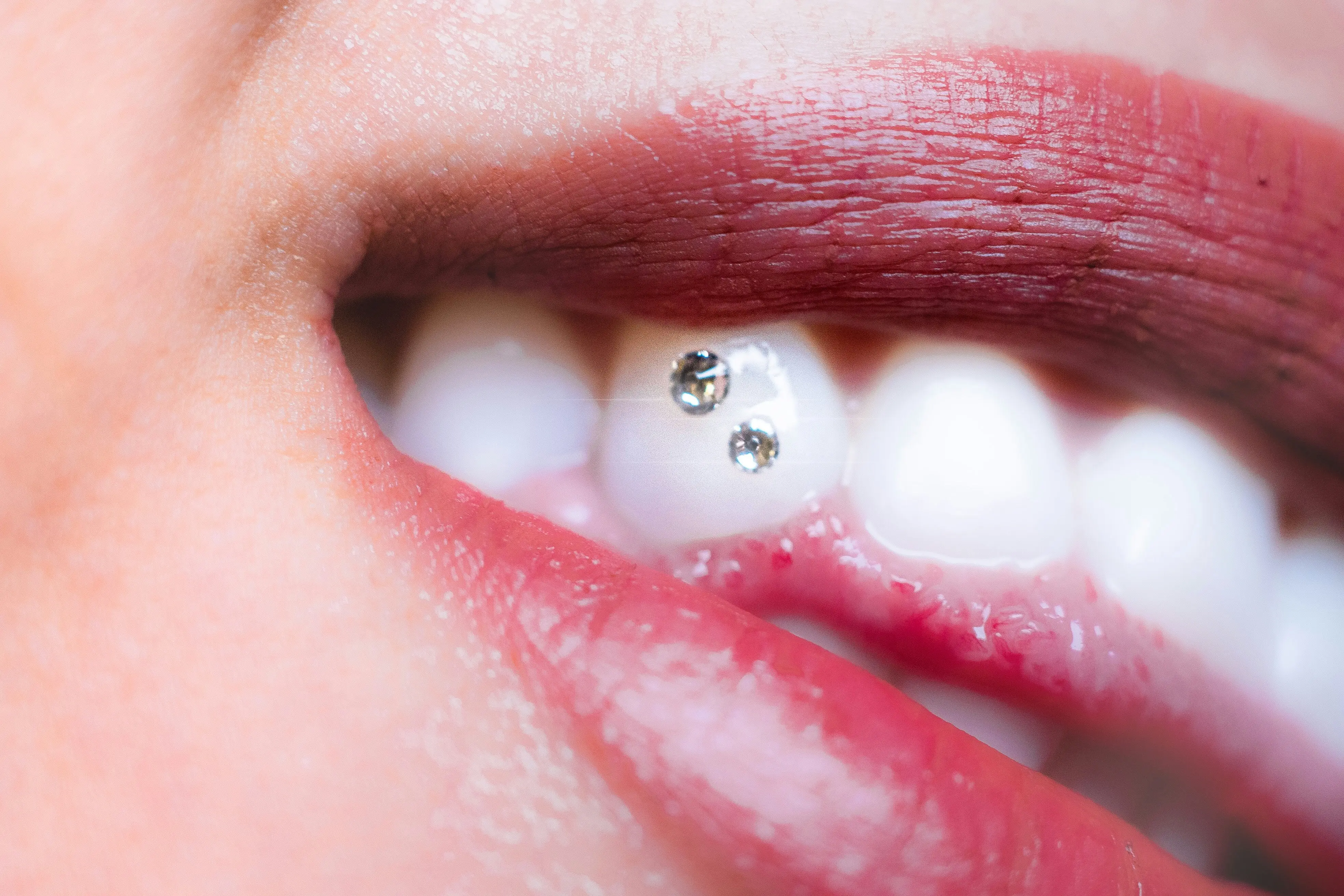 Dental Jewellery