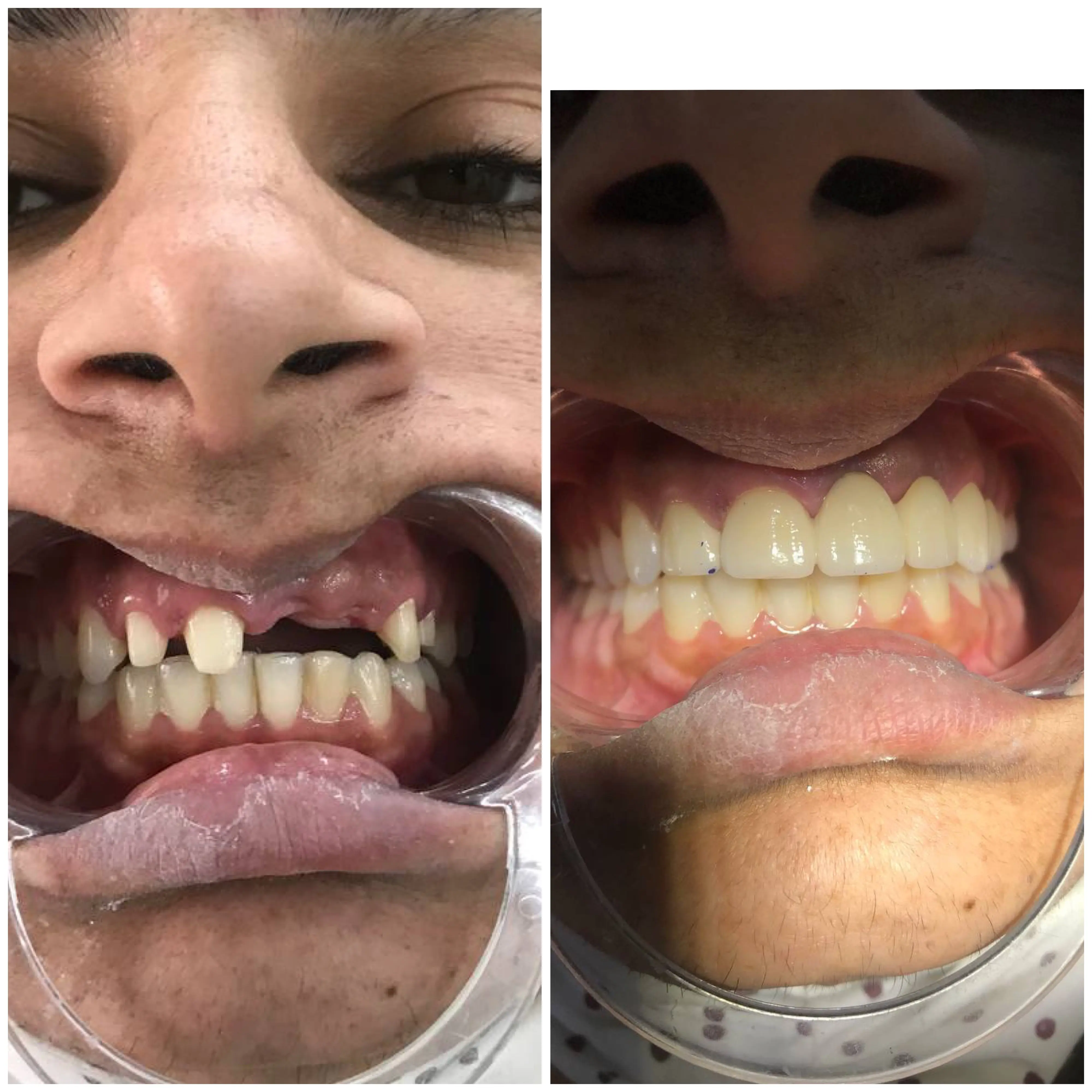 Before and After